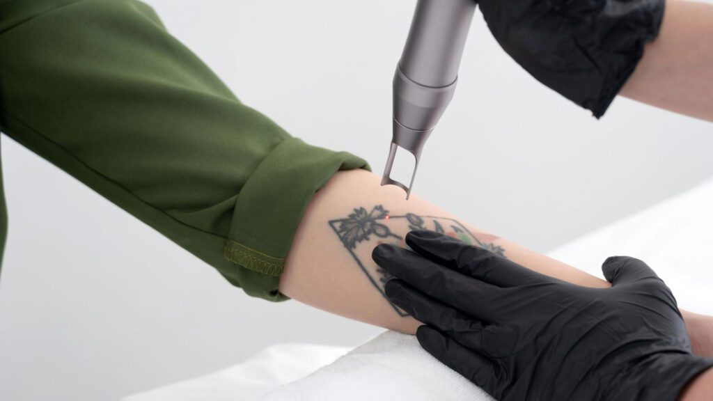 Tattoo laser treatment for fading tattoos